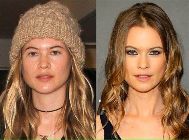 Behati Prinsloo Plastic Surgery