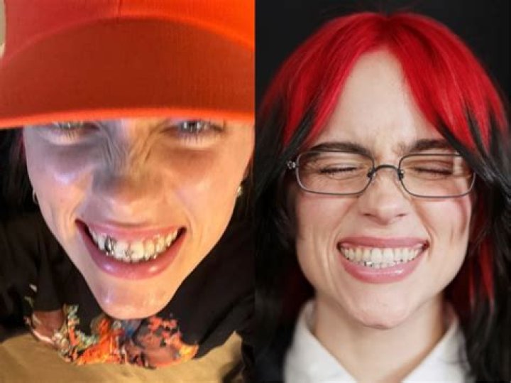 Billie Eilish teeth