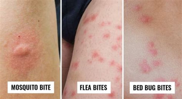 Does charcoal help bug bites?