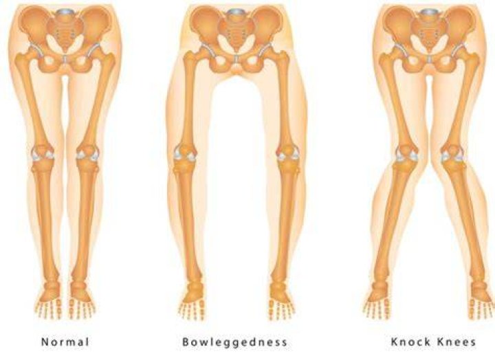 Is miserable malalignment syndrome rare?